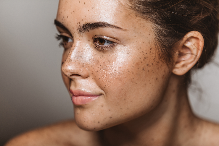 What Are Freckles & What Causes Them?